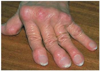 Rheumatoid arthritis remission provides superior outcomes