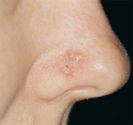 New Pills Stop Progress Of Skin Cancer By Half