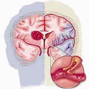 90pct of strokes are triggered by 10 risk factors