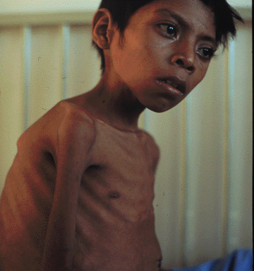 Tuberculosis Patient