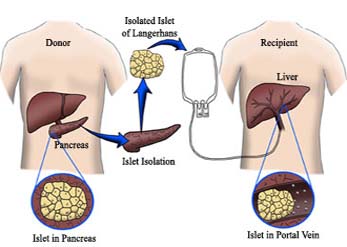 A sea change need- Transplantation Act