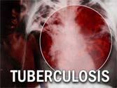 China launches partnership to fight drug-resistant TB 