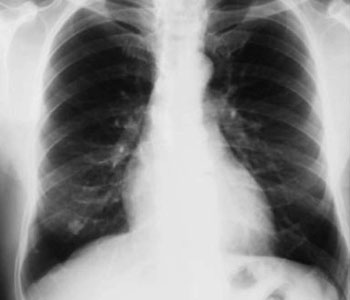 Tuberculosis Cases Decline In India