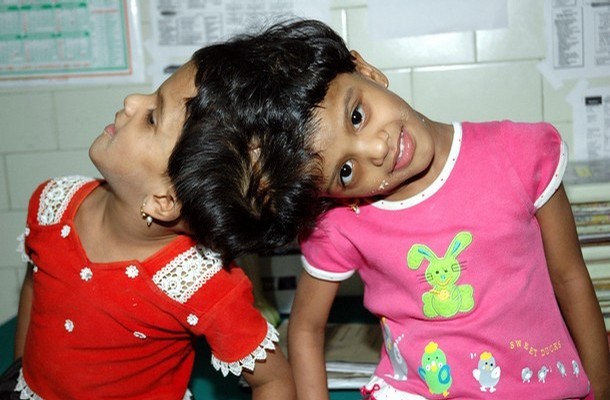 Plan for separation of conjoined Indian twins stirs debate