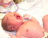 Baby Born by C-Section