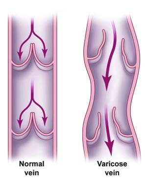 Family history linked to increased blood clot risk