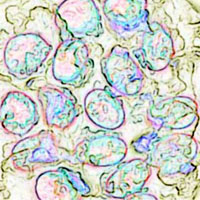 Breast-cancerous-cells