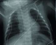 Exposure to air pollution increases infants'' bronchiolitis risk