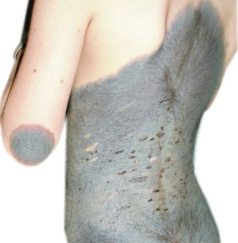 Dry Discoloured Patch Skin