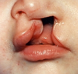 Gel for repairing cleft lips