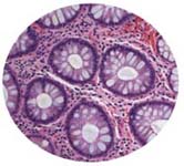 Colon Cancer Cells