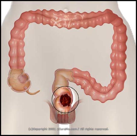 Regulating intestinal inflammation may be the key to prevent colon cancer