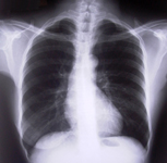 Chronic Obstructive Pulmonary Disease