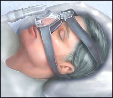 CPAP