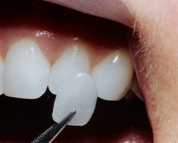 dental filling and reconstruction