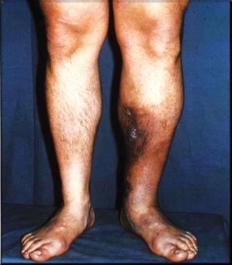 Vein Thrombosis