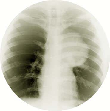 Novel method to identify early-stage lung cancer
