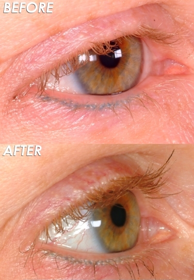 first-ever eyelash transplant