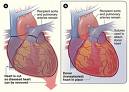 Study: Same Gender Heart Transplants More Successful