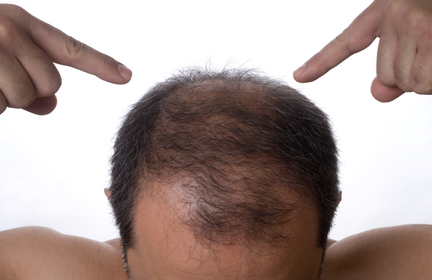 Stem cells that trigger hair growth may lead to new treatment for baldness
