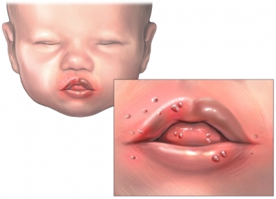 hand, foot and mouth disease