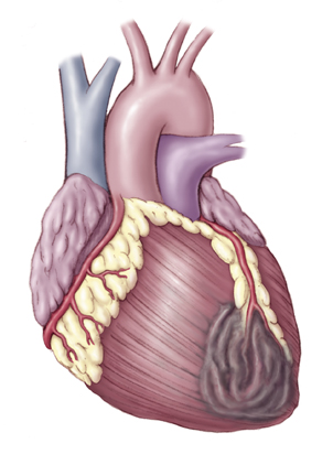 (a) increases heart attack heart attack. (a) increases heart attack