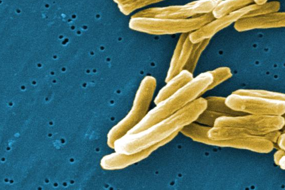  Now, a faster, cheaper test to diagnose TB