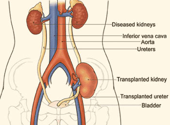 Weight Of Donors And Recipients Boosts Success In Kidney Transplants