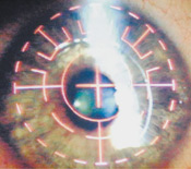 Laser eye surgery has no long-term effects on cornea