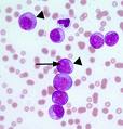 leukemia