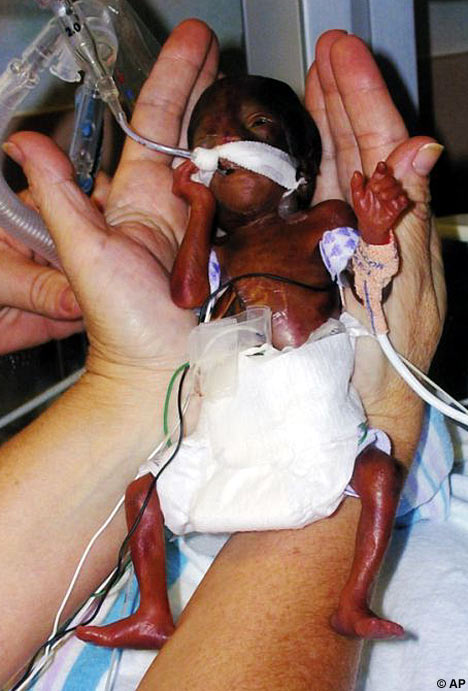 Jaipur doctors save world’s lightest baby