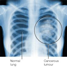 Lung Cancer Treatment is Race Oriented