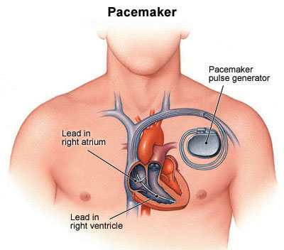 Natural solution to artificial heart pacemakers may be possible