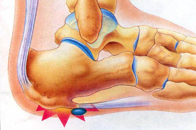 Foot Arch Pain