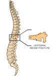 Postmenopausal Bone Loss