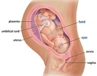 Preeclampsia