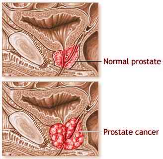 prostate cancer 