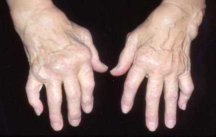 Aerobic Workout Advantageous For RA Patients
