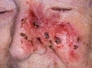 Skin Cancer