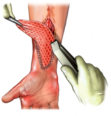 skin transplant surgical