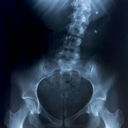 spinal-surgery