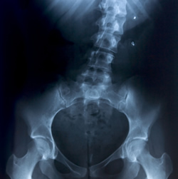spinal-surgery