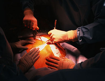 Doctors Remove 8 Kg Tumour From Cancer Patient's Stomach