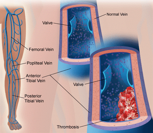 Sitting in plane’s window seat ''raises thrombosis risk’