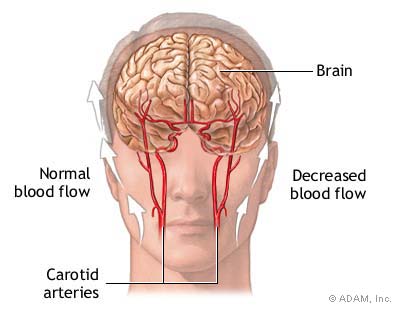 transient ischemic attack