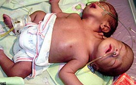 births impossible baby survive life expectantcy unknown two-headed baby observation
