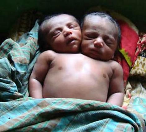 births impossible baby survive life expectantcy unknown two-headed baby observation births impossible baby survive life expectantcy unknown two-headed baby observation