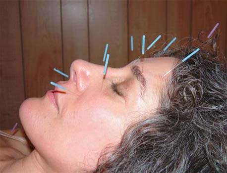 Acupuncture ‘ineffective’ against menopausal hot flushes