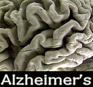 Drug may improve memory of Alzheimer’s patients