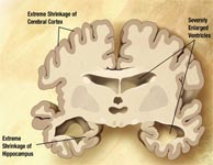 Alzheimer's Disease